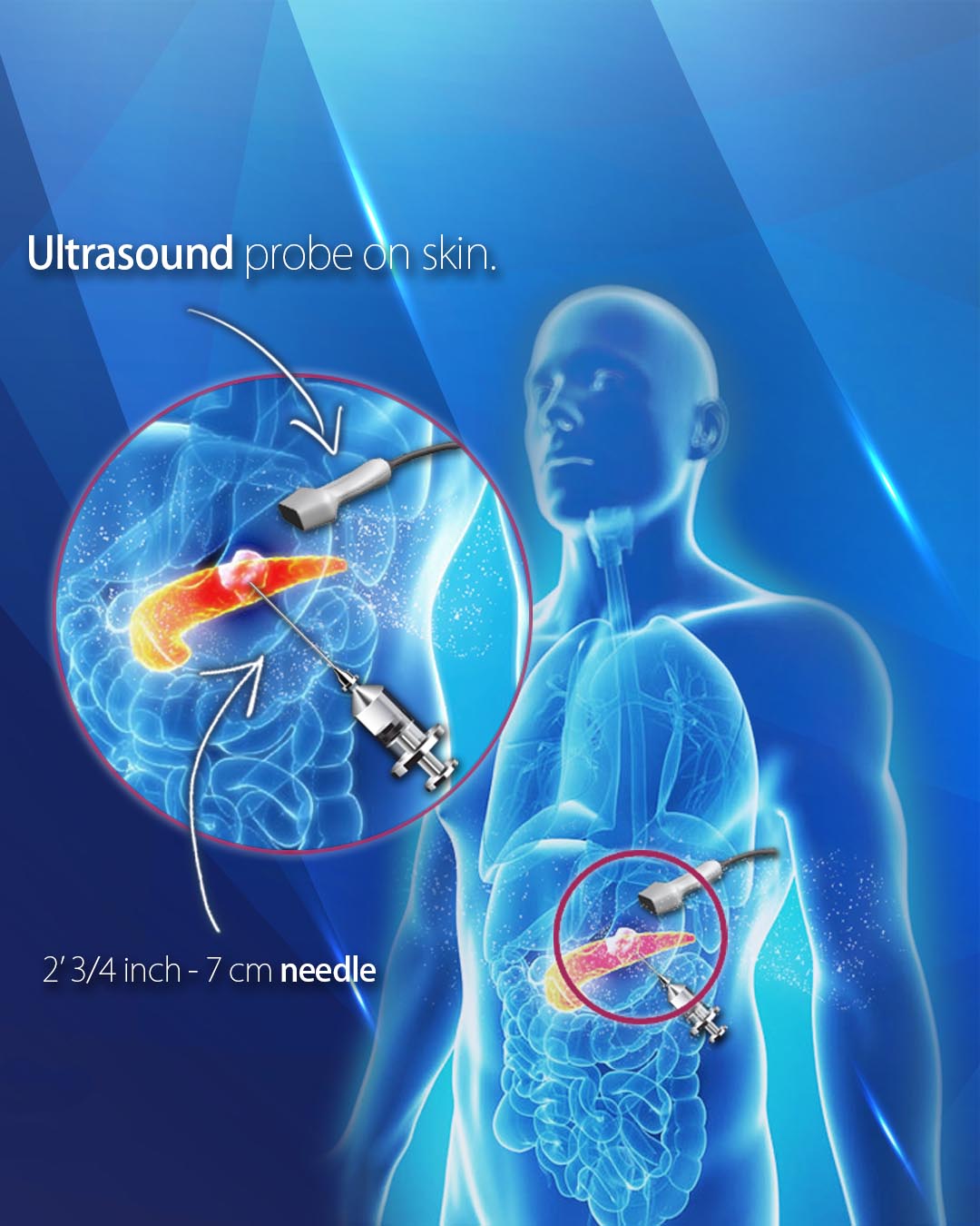 Cancer Ultrasound